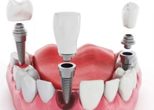 Виды и стоимость имплантации зубов