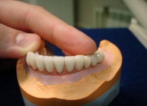 Особенности протезирования на зубных имплантах