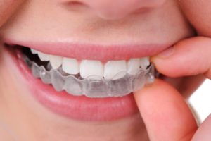 Преимущества стоматологических элайнеров