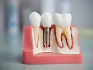 Современные способы имплантации зубов