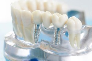 Как происходит имплантация зубов