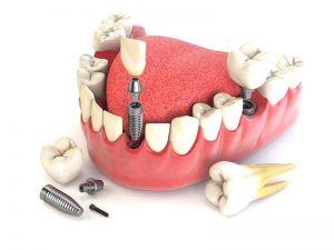 Процедура имплантирования зубов