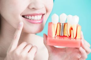 Имплантация зубов в стоматологии Грузии