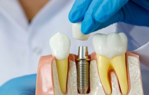 Преимущества, недостатки и риски имплантации зубов