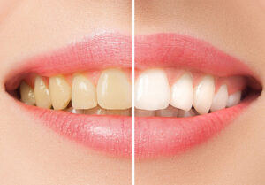 Причины изменения цвета зубной эмали