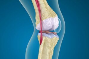 Артроз коленного сустава: симптомы, причины возникновения и методы лечения