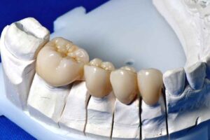 Циркониевые коронки для зубов: особенности и преимущества