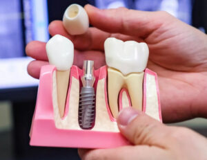 Почему не нужно затягивать с установкой зубных имплантатов