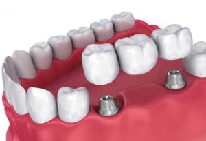 Протезирование зубов: когда стоит проводить и когда не стоит