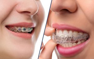 Эстетическая ортодонтия: что из себя представляет