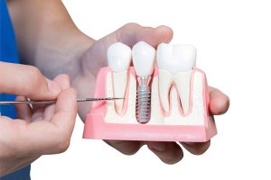 Виды имплантации зубов