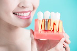 Типы имплантации зубов: Основные методы и их преимущества в стоматологии