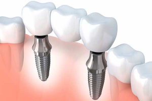 Имплантация зубов по системе Megagen: особенности процедуры и преимущества