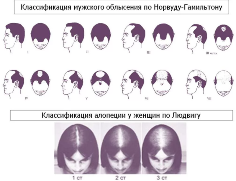 Андрогенетическая алопеция: как распознать?