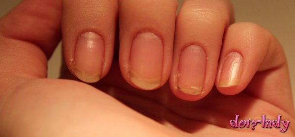 Воспаление кожи вокруг ногтей – симптомы и лечение