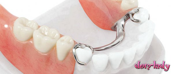 Как устроены бюгельные зубные протезы?