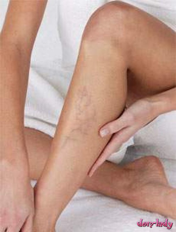 Как лечить варикозное расширение на ногах у женщин 