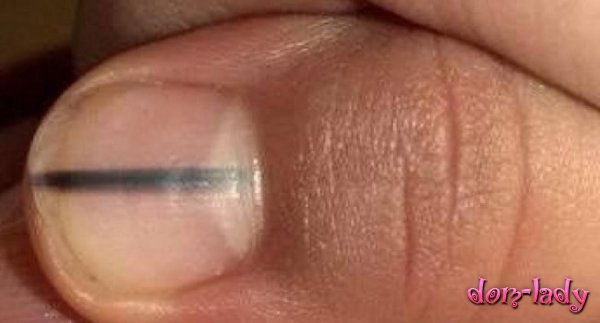 Специалист по маникюру заподозрила у клиентки рак из-за полоски на ногте