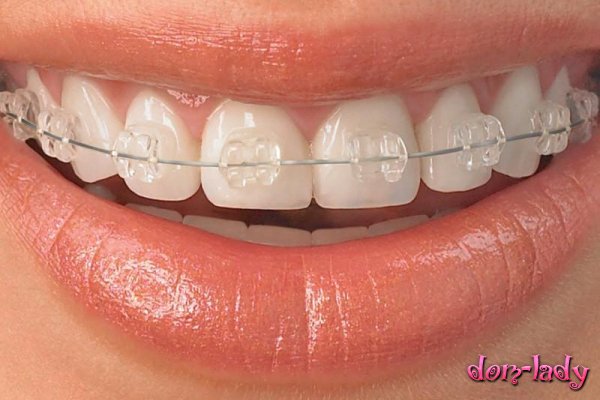 Когда стоит установить металлические брекеты на зубы