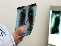Исследователи приблизились к созданию новой вакцины от туберкулеза