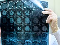 Открытие: сотрясение мозга и болезнь Альцгеймера тесно связаны