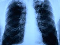 Необычный аэрозоль обещает перевернуть представления о лечении туберкулеза