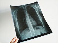 Исследователи поняли, почему "российский туберкулез" один из самых страшных