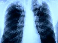 Специалисты приблизились к победе над туберкулезом, устойчивому к антибиотикам