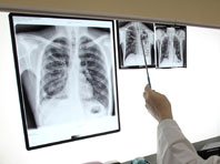 Специалисты называют туберкулез новым аутоиммунным заболеванием