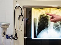 Смертность от туберкулеза постепенно снижается, говорят эксперты