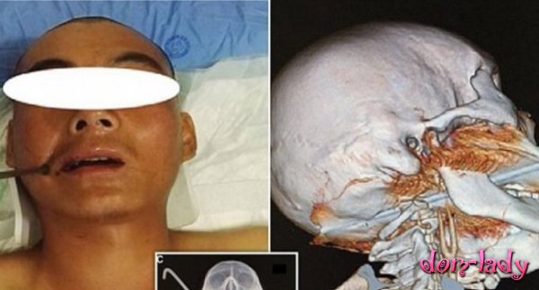 Хирурги спасли парня с металлическим стержнем в черепе