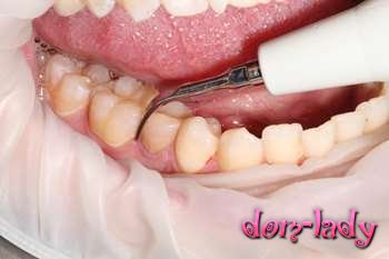 Зубной камень: причины появления, способы удаления