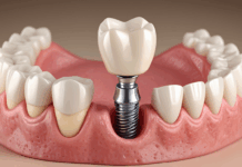 Имплантация зубов у пожилых пациентов: особенности, риски и рекомендации