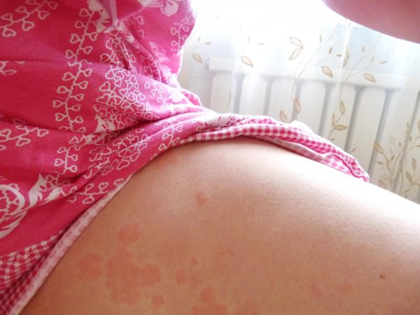 Лечение дерматита в домашних условиях
